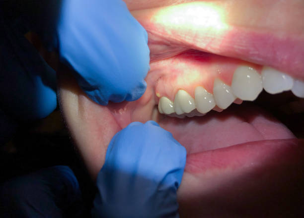 Best Chipped Tooth Repair Near Me  in Pierceton, IN